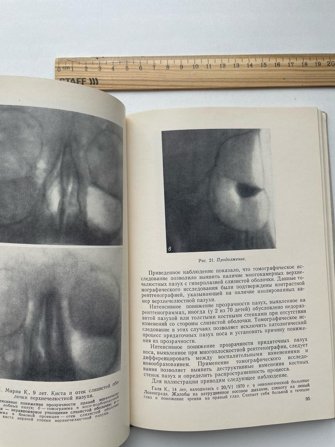 И.Н. Шац Синуиты у детей при стрептококковой инфекции и острых респираторных заболеваниях — фото 2